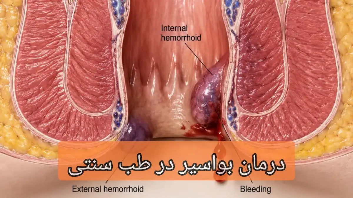 درمان بواسیر در طب سنتی-میرصالحی