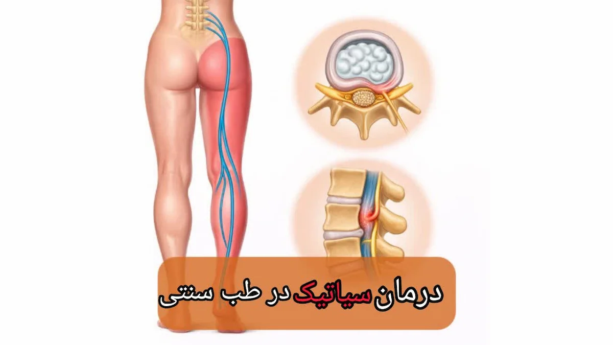 درمان سیاتیک در طب سنتی-میرصالحی