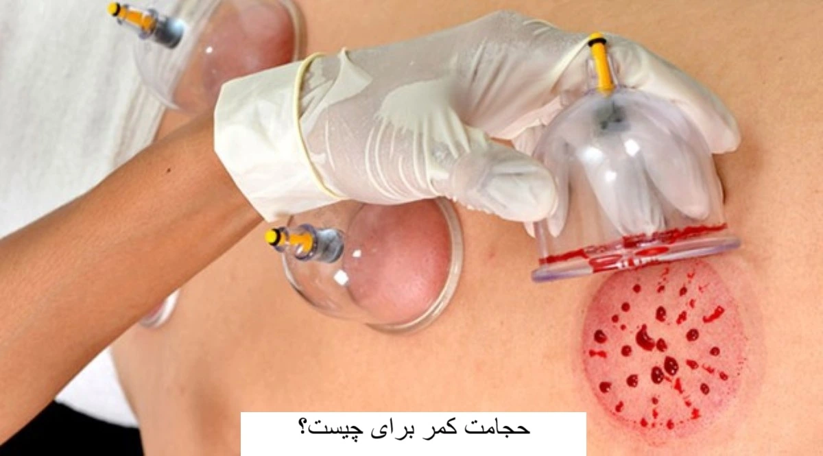 حجامت-کمر-برای-چیست؟-میرصالحی