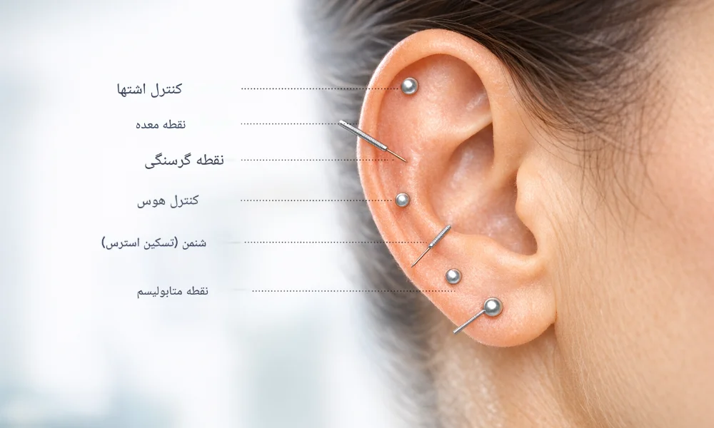 طب سوزنی گوش برای لاغری-میرصالحی