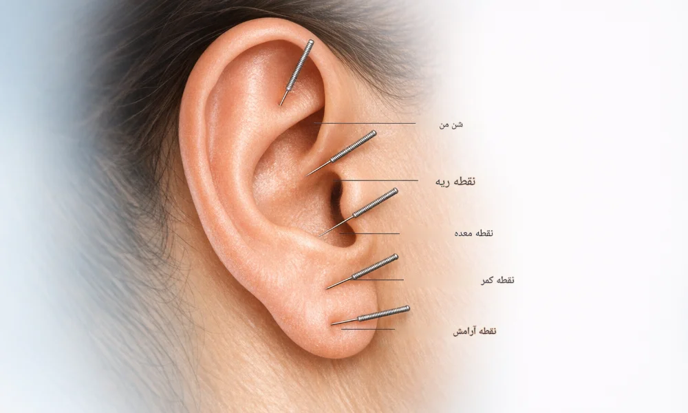 طب سوزنی گوش برای چیست؟-میرصالحی