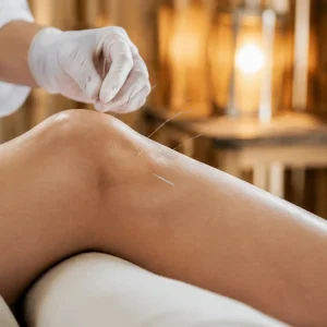 طب سوزنی برای زانو-میرصالحی